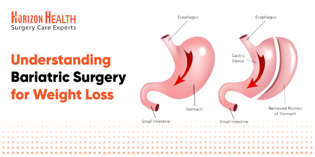 Understanding Bariatric Surgery for Weight Loss