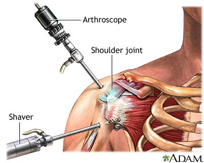 Arthroscopy Treatment