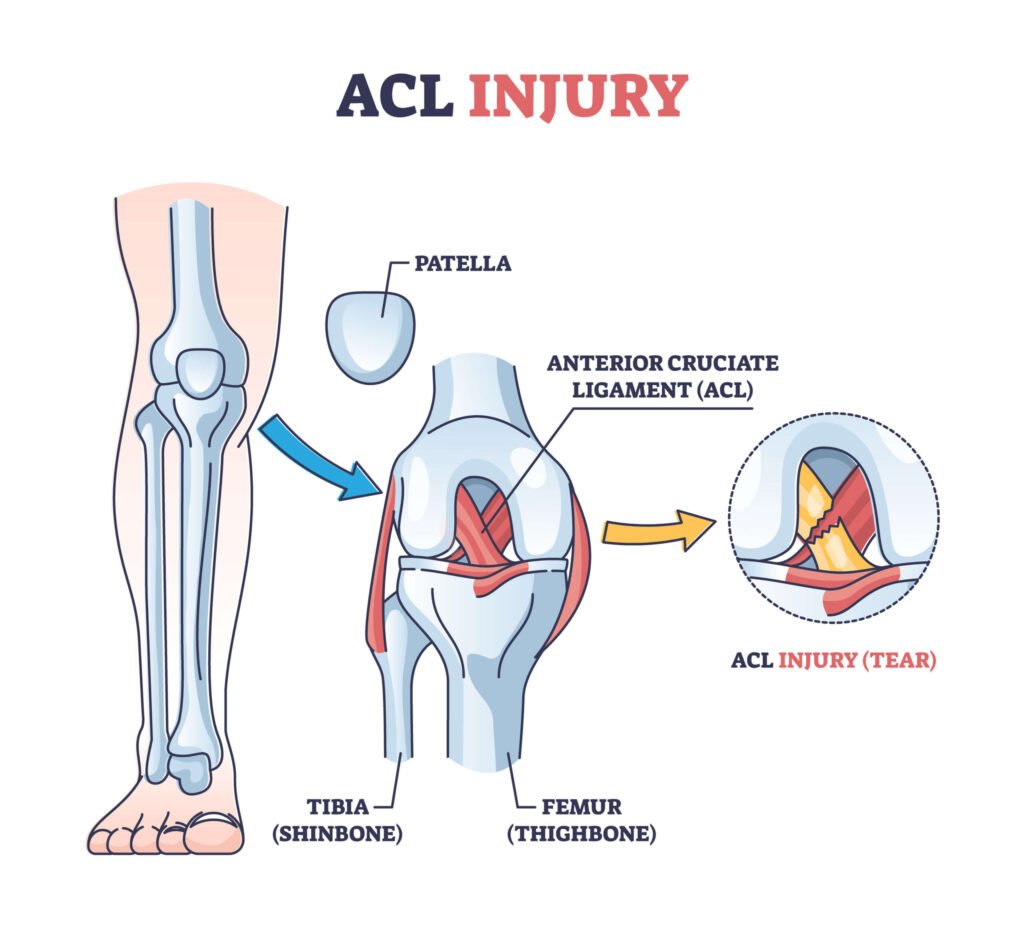 Acl injury treatment
