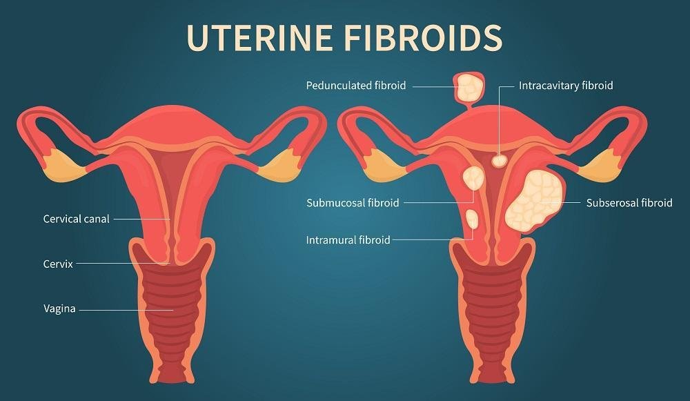 Uterine fibroids