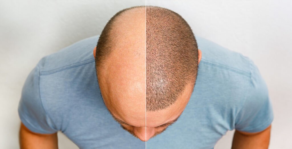 Hair Transplant