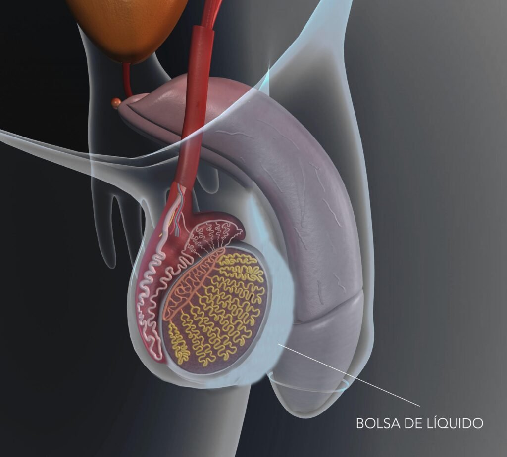 hydrocele treatment