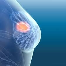 Breast Lumps Treatment