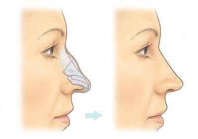 Rhinoplasty Treatment